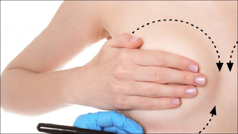 Bí Quyết Chăm Sóc Sau Phẫu Thuật Cắt Ngực Để Đạt Kết Quả Tốt Nhất